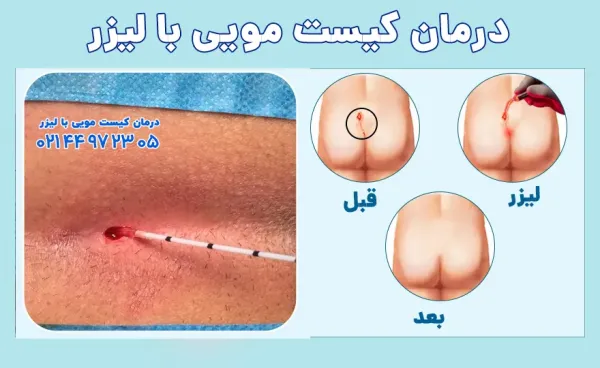  هزینه عمل کیست مویی با دفترچه تامین اجتماعی