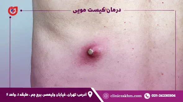 کدام روش عمل کیست مویی بهتر است؟