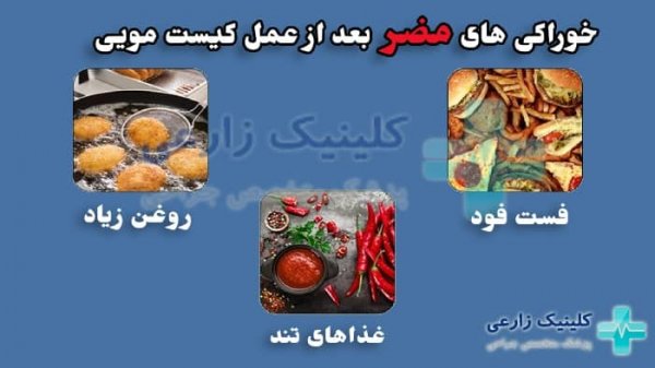  کدام روش عمل کیست مویی بهتر است؟