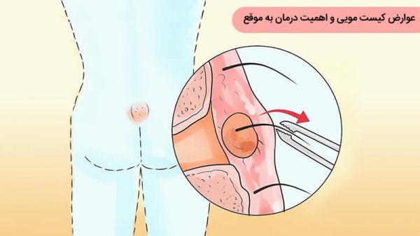 کیست مویی چه عوارضی دارد؟