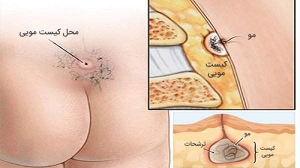  کیست مویی چه عوارضی دارد؟