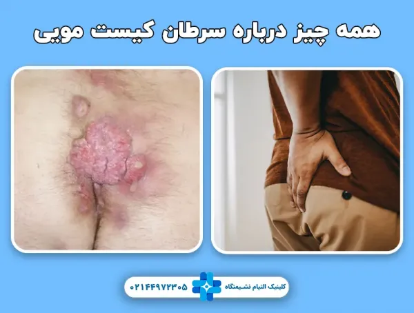 عکس سرطان کیست مویی