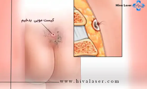  عکس سرطان کیست مویی