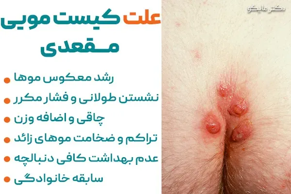  عکس سرطان کیست مویی