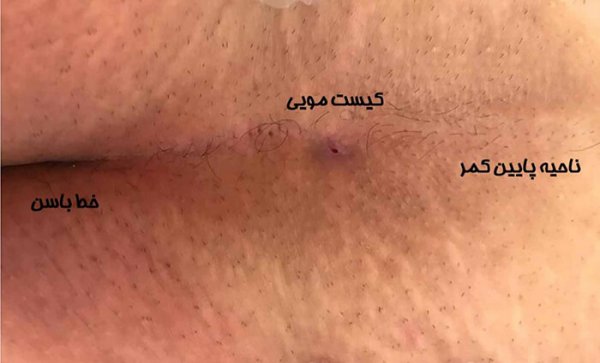  کیست مویی در چه سنی ایجاد میشود؟