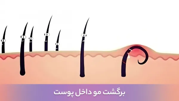  کیست مویی در چه سنی ایجاد میشود؟