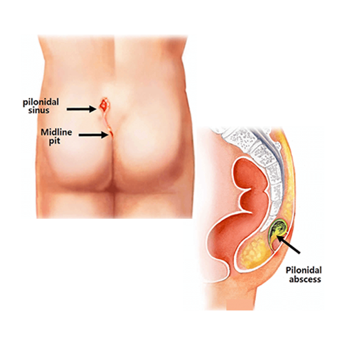 چه زمانی کیست مویی نیاز به جراحی دارد؟