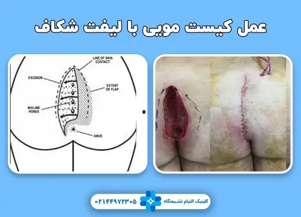  چه زمانی کیست مویی نیاز به جراحی دارد؟