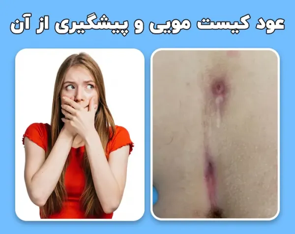 عکس کیست مویی عود کرده