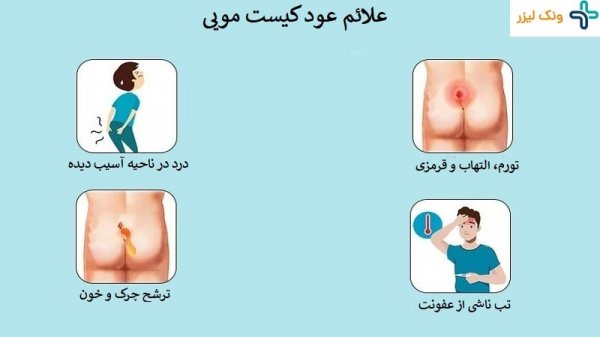 عکس کیست مویی عود کرده