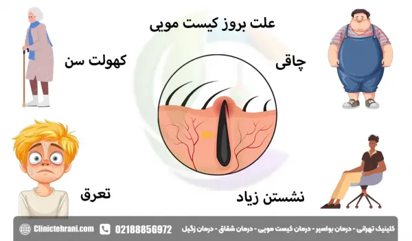  عکس کیست مویی عود کرده
