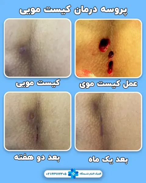  عکس کیست مویی عود کرده