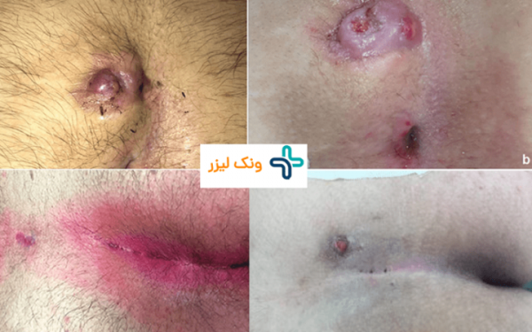  عکس کیست مویی عود کرده