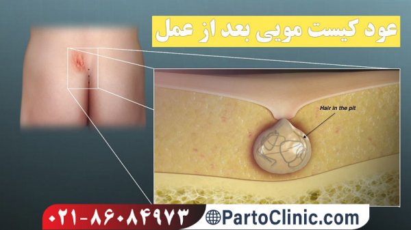  عکس کیست مویی عود کرده