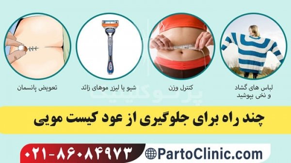  عکس کیست مویی عود کرده