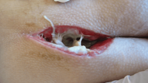 علت ترشحات بعد از عمل کیست مویی