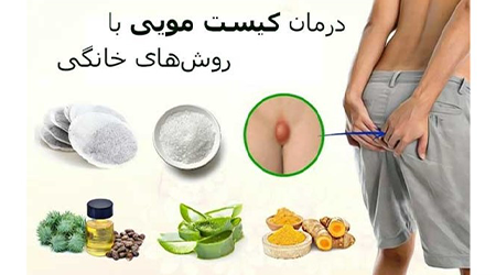  علت ترشحات بعد از عمل کیست مویی