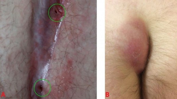  علت ترشحات بعد از عمل کیست مویی