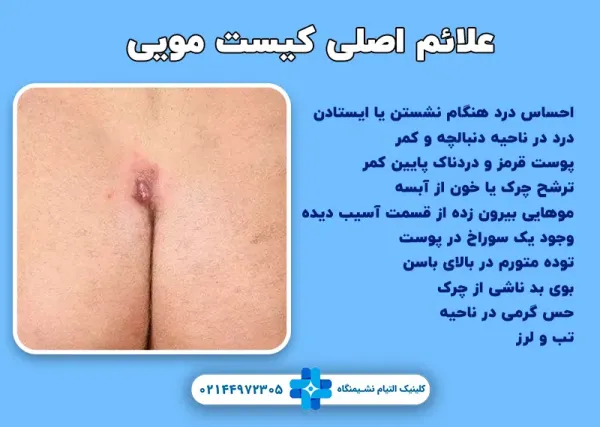  علت ترشحات بعد از عمل کیست مویی