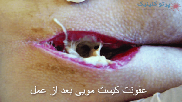  علت ترشحات بعد از عمل کیست مویی