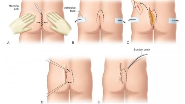  بعد از عمل کیست مویی چگونه حمام کنیم؟