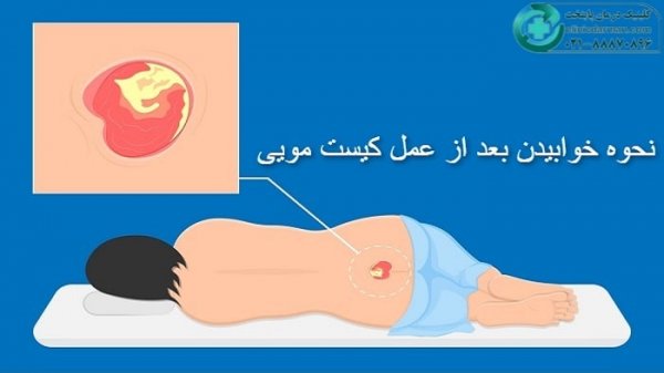  بعد از عمل کیست مویی چگونه حمام کنیم؟