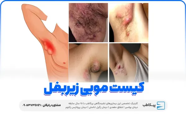 عکس کیست مویی در کشاله ران + عکس کیست مویی زیر بغل