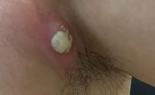  عکس کیست مویی در کشاله ران + عکس کیست مویی زیر بغل