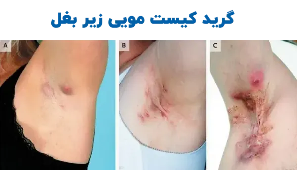  عکس کیست مویی در کشاله ران + عکس کیست مویی زیر بغل