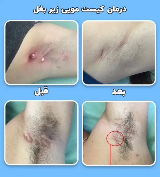  عکس کیست مویی در کشاله ران + عکس کیست مویی زیر بغل