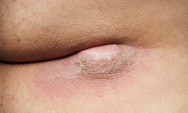  عکس کیست مویی واژن