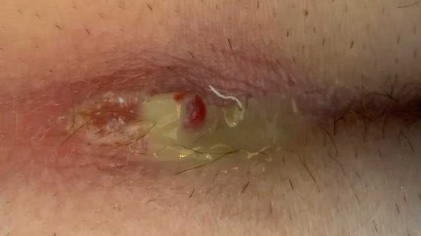  عکس کیست مویی واژن