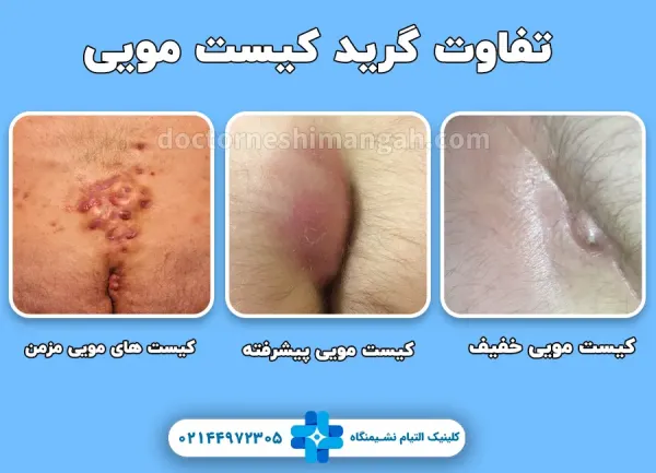  عکس کیست مویی واژن