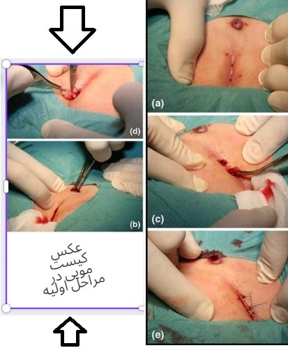  عکس کیست مویی واژن