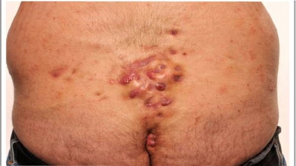  عکس کیست مویی واژن