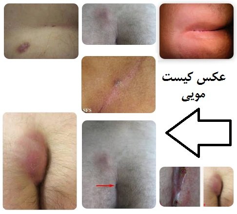 عکس انواع کیست مویی + عکس کیست مویی خارج شده