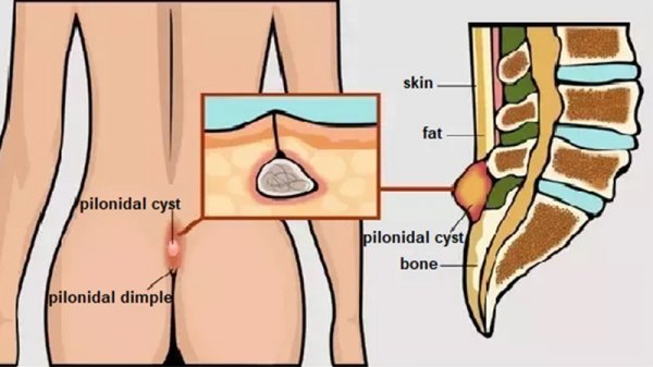  عکس انواع کیست مویی + عکس کیست مویی خارج شده