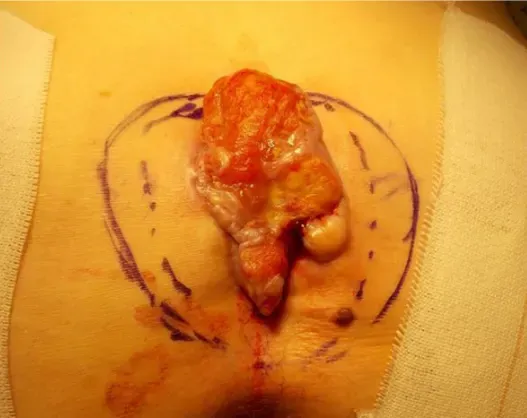  عکس انواع کیست مویی + عکس کیست مویی خارج شده