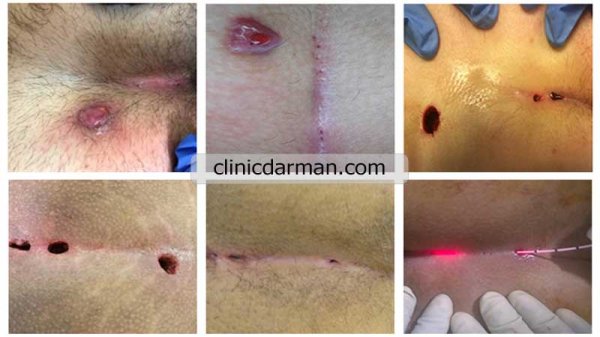  عکس انواع کیست مویی + عکس کیست مویی خارج شده