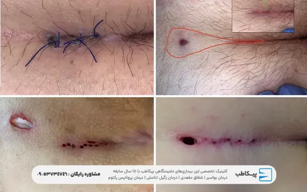  عکس انواع کیست مویی + عکس کیست مویی خارج شده