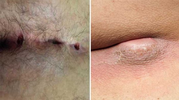  عکس انواع کیست مویی + عکس کیست مویی خارج شده