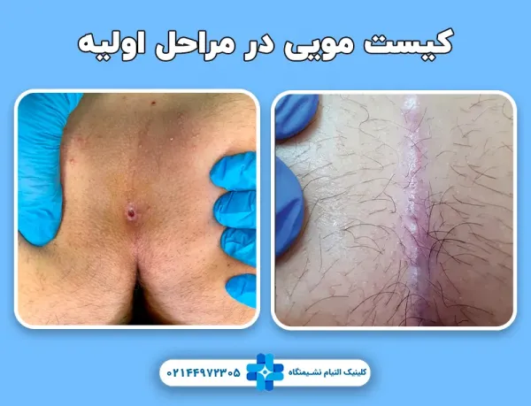  عکس انواع کیست مویی + عکس کیست مویی خارج شده