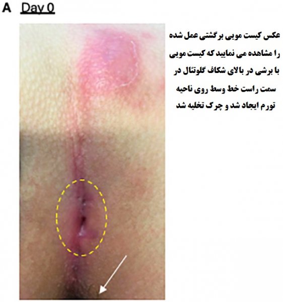  عکس انواع کیست مویی + عکس کیست مویی خارج شده