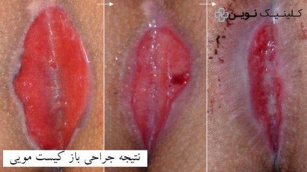  عکس انواع کیست مویی + عکس کیست مویی خارج شده