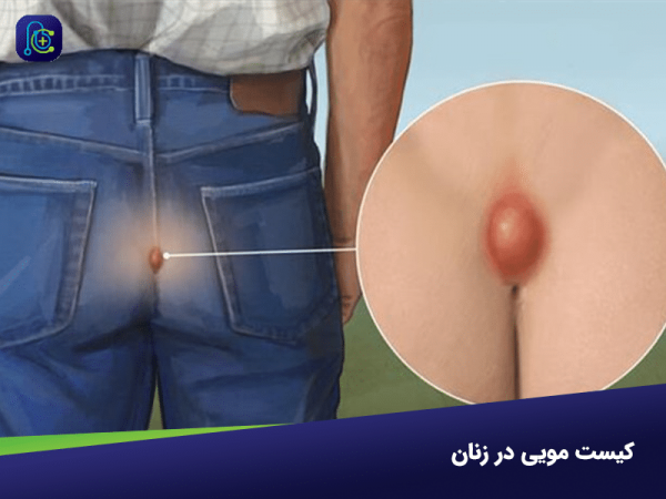 عوارض کیست مویی در زنان