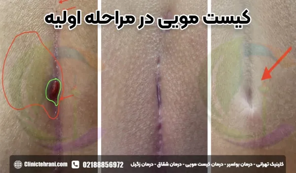  عوارض کیست مویی در زنان