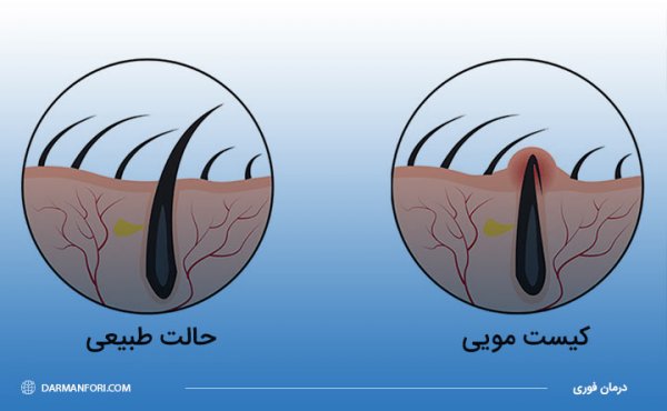  عوارض کیست مویی در زنان