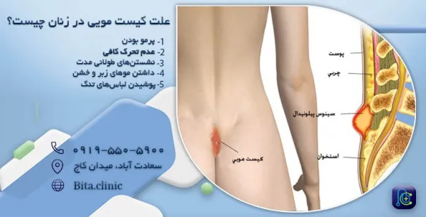  عوارض کیست مویی در زنان