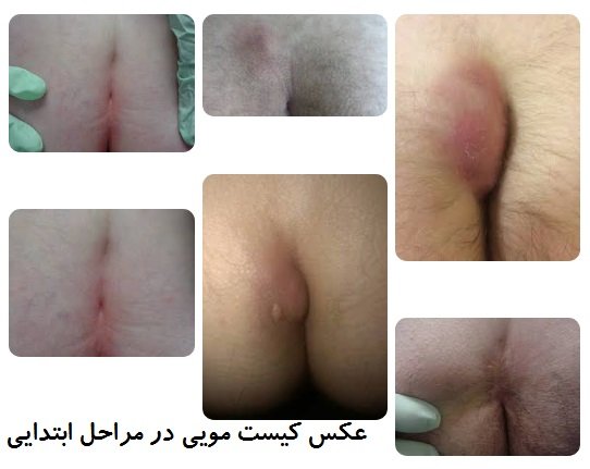  عوارض کیست مویی در زنان