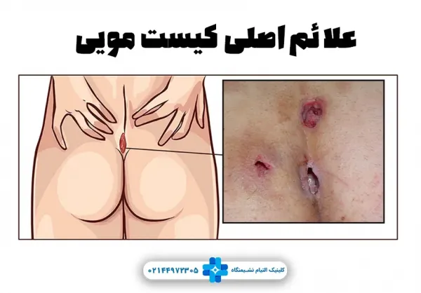 علائم ظاهری کیست مویی